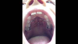 Palatal Expander Getting Braces On Nirenblatt Orthodontics [upl. by Goth]