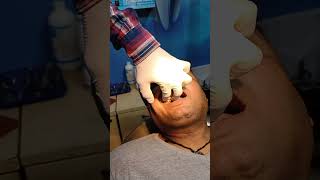 THE UPPER SECOND PREMOLAR TOOTH EXTRACTION [upl. by Eiramlatsyrc660]