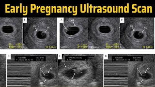 Early Pregnancy Ultrasound  Ultrasound 4 Weeks Pregnant  5 Weeks Pregnant Ultrasound [upl. by Sharron]