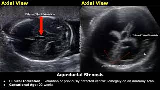 Fetal Brain Ultrasound Reporting  Obstetric Brain Pathologies Scan Reports  Pregnancy USG [upl. by Orban33]