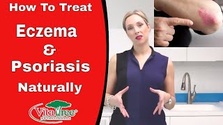 How To Treat Eczema Fast  Treat Psoriasis Naturally  VitaLife Show Episode 180 [upl. by Kessia]