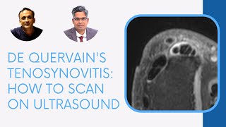 DE QUERVAINS TENOSYNOVITIS HOW TO SCAN ON ULTRASOUND [upl. by Atsirtal]