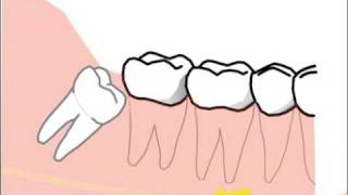 alte Version Erklärung spezieller Probleme und Risiken bei der Weisheitszahnentfernung [upl. by Amarillas]