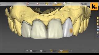 Anterior Crown design with Dentsply Sirona inLab CAD 180  CEREC Bluecam  Vladyslav Pereverzyev [upl. by Aekim]