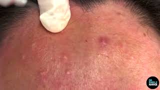 Comedones Galore on Face and Forehead Dr Pimple Popper Pops amp Removes Comedones [upl. by Doralynn]