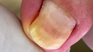 Thoroughly Clean Up Broken Toenails amp Onychomycosis Treatment [upl. by Nueoras527]