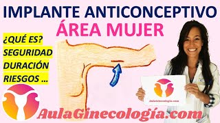 IMPLANTE ANTICONCEPTIVO ¿QUÉ ES SEGURIDAD DURACIÓN RIESGOS  Ginecología y Obstetricia [upl. by Habas]