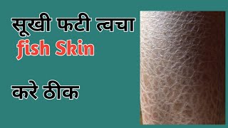 Ichthyosis Vulgeris Cause Symptoms and Treatment Hindi [upl. by Gherardo]