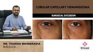 LOBULAR CAPILLARY HAEMANGIOMA  SURGICAL EXCISION  DR YOGESH BHINGRADIA [upl. by Zedecrem]