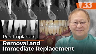 Periimplantitis Removal and Immediate Replacement [upl. by Einalem]