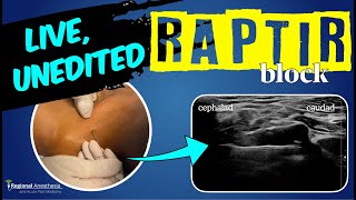 RAPTIR block start to finish Retroclavicular Approach to the Infraclavicular Region [upl. by Ennovart11]