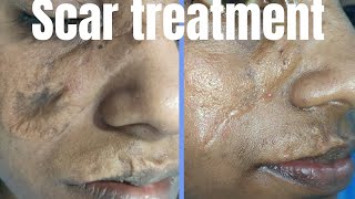 Scar revision surgery  Result after 5 month Laser scar revision surgery in Ranchi scar nisan [upl. by Ender470]