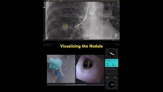 Direct visualization of the lung nodule bronchoscopy [upl. by Faustus]