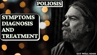 Poliosis Symptoms Diagnosis and Treatment [upl. by Enobe]