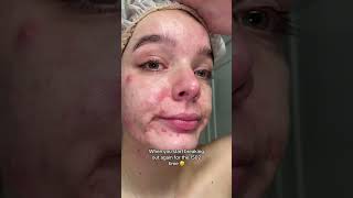 Coming to terms with my acne on my skin healing journey realskin [upl. by Lunetta]