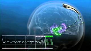 An Implant to Prevent Seizures [upl. by Uy]