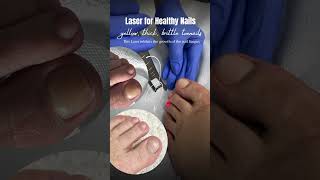 Laser treatment for toenail amp nail fungus T 043484406 pedicure manicure nailsalon salon [upl. by Notak]