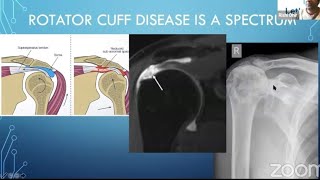 Rotator Cuff Disease for the FRCSOrth [upl. by Gellman]