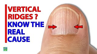 Did You Know The REAL Cause of VERTICAL RIDGES On Your Nails [upl. by Nivi559]