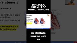 Diastolic Murmur of Mitral Stenosis  MCCQE1 [upl. by Foushee63]