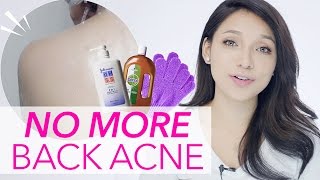 Get Rid of Back AcnePimple in ONE WEEK GDiipa [upl. by Anav553]