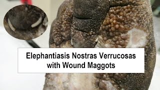 Elephantiasis Nostras Verrucosas and Wound Maggots [upl. by Analrahc347]