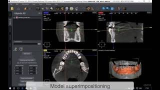 QuickVision 3D Superimpositioning OWANDY RADIOLOGY [upl. by Hgielrebma]