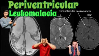 Periventricular Leukomalacia  MRI BRAIN 🧠 [upl. by Bennink]