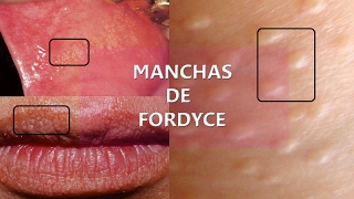 Manchas de Fordyce una confusión con VPH [upl. by Anilyx]