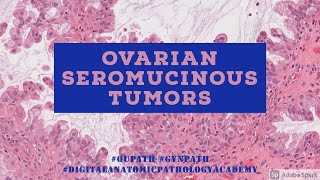 Seromucinous borderline tumor of ovary [upl. by Brooking562]