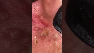 blackheadremoval blackhead skincare [upl. by Malachi]