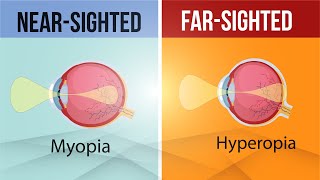 Difference in Myopia and Hyperopia  Nearsighted and FarSighted Lens  Class 10  Letstute CBSE [upl. by Aremaj]