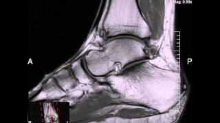 MRI on my ankle [upl. by Asiar]