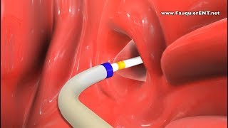 Balloon Eustachian Tube Dilation to Treat Eustachian Tube Dysfunction [upl. by Soirtemed86]