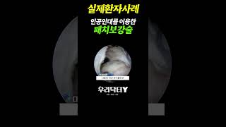 회전근개 파열시 인공인대를 이용한 수술방법 수술장면 [upl. by Nwahsaj]