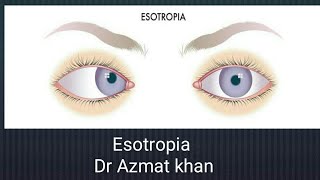 Esotropia part 2 [upl. by Eidoc]