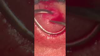 Chalazion surgery Chalazion Expert Advice for Quick Healing [upl. by Serrano]