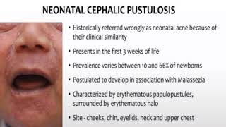 case 316 neonatal cephalic pustulosis neonatal Acne erythema toxicum HSV herpes virus [upl. by Hobart146]