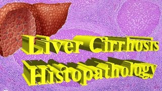 Liver Cirrhosis Histopathology quotHampEquot [upl. by Trotter]