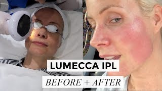 LUMECCA IPL  BEFORE  AFTER  Liv Judd [upl. by Pauly733]