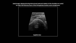 Fullthickness tear of the infraspinatus tendon on shoulder ultrasound [upl. by Ehcrop]