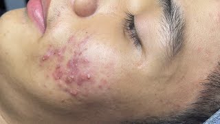 ACNE TREATMENT VU QUYNH MI  Perennial Blackheads On Boy Face 2024FULL [upl. by Ylluz]