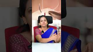 How Many Stitches Do You Get During Normal Delivery  Essential Tips  Dr Shilpa GB [upl. by Trometer]