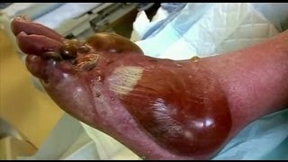 Pus Filled Blisters  Bizarre ER [upl. by Schram]