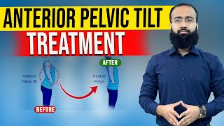 Get Rid Of Anterior Pelvic Tilt Fast With Easy Home Remedies [upl. by Celestyna]