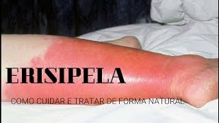 ERISIPELA  Saiba como cuidar e tratar de forma natural  Dr Edelson Beling [upl. by Nnazil817]