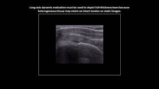 Fullthickness tear of the supraspinatus tendon on shoulder ultrasound case 3 [upl. by Ojiram]