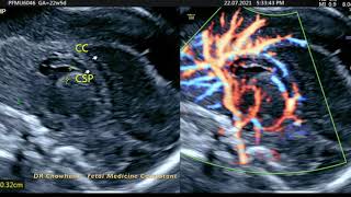 PARTIAL Agenesis of Corpus Callosum [upl. by Atsyrk]