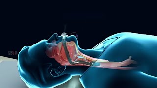 Cervical Lymph Node Dissection Surgical Procedure Risks and Complications [upl. by Mcfarland679]