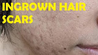 how to get rid of ingrown hair scars on face [upl. by Seppala]